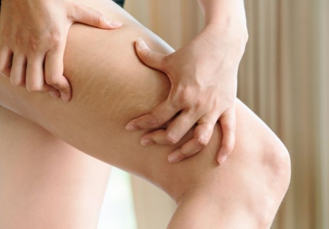 Properties of aloe vera for stretch marks